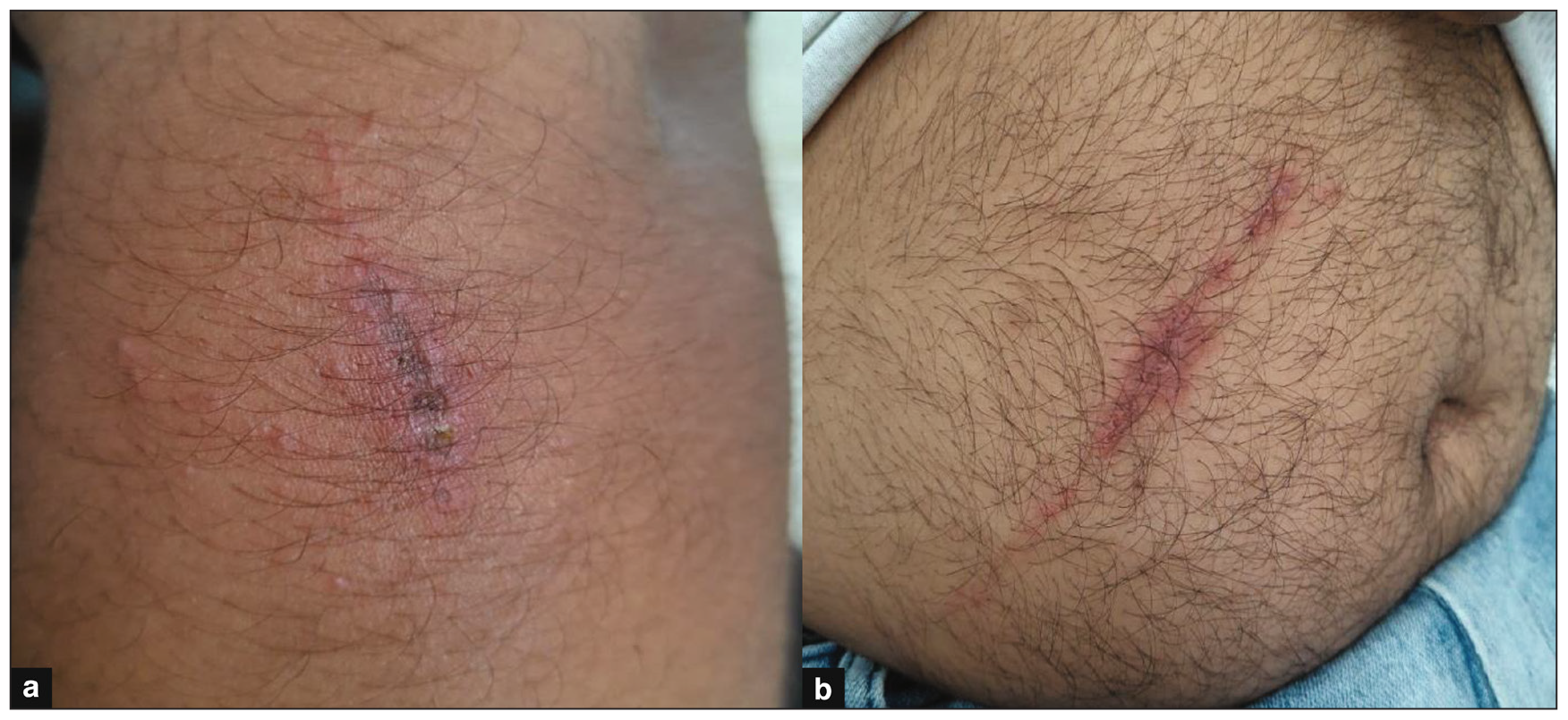 Linear Lesion (a) 23 year old male, liner lesion on fore arm (b) 30 year old male, linear lesion on abdomen.