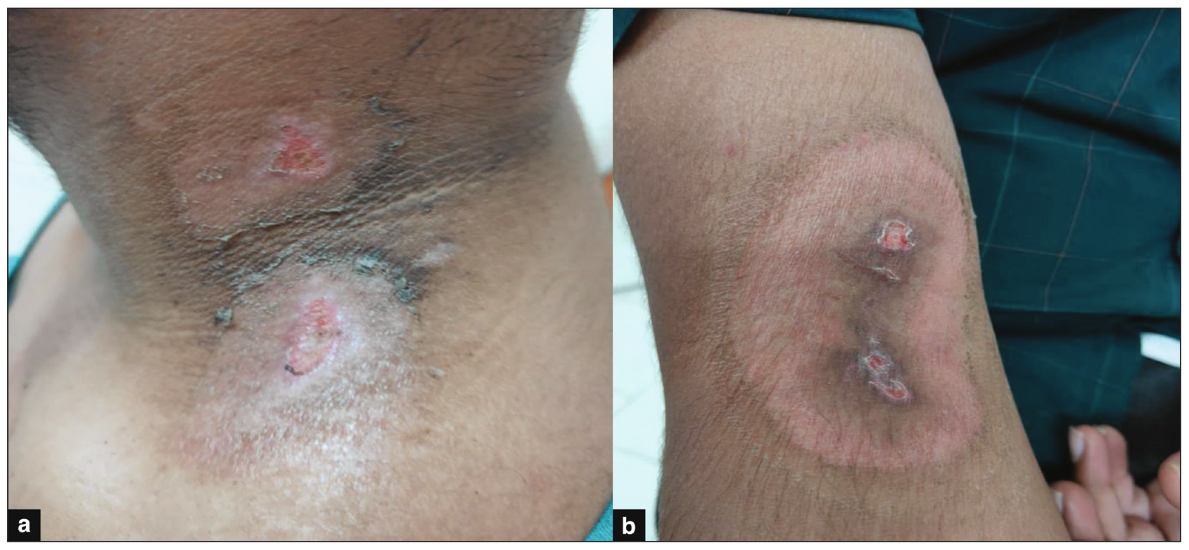 Kissing Lesion (a) 22 year- male, kissing lesion on neck (b) 30 year-male, kissing lesion on elbow joint.