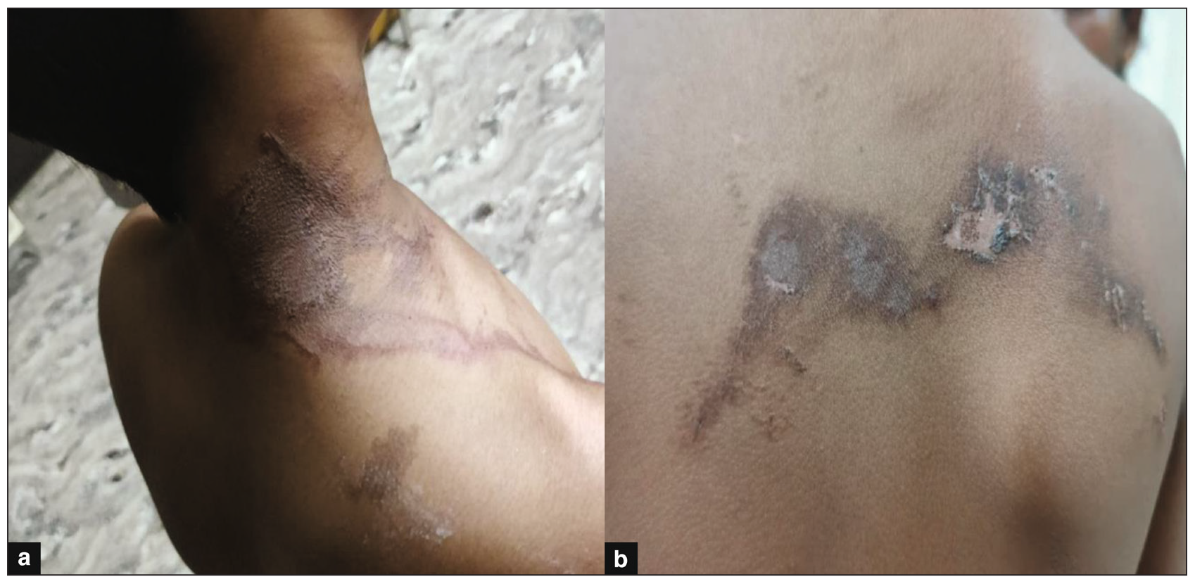 Burnt out Lesion (a) 7-year-old boy, burnt out lesion on neck (b) 10 years -male, burnt out lesion on back.