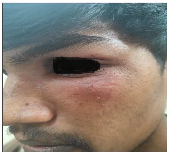 Peri Orbital Involvement, 16 years- male, lesion in peri orbital area.