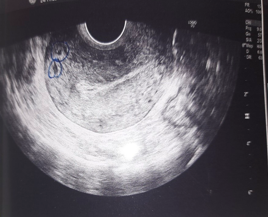 Normal sized uterus with empty cavity and thin endometrium in ultrasonography. Blue circles indicates adenomyotic changes in uterus.