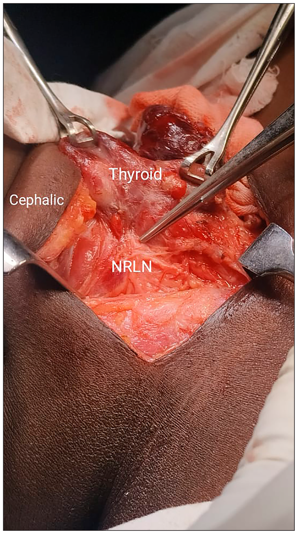 Intraoperative picture. NRLN: Non-recurrent laryngeal nerve.