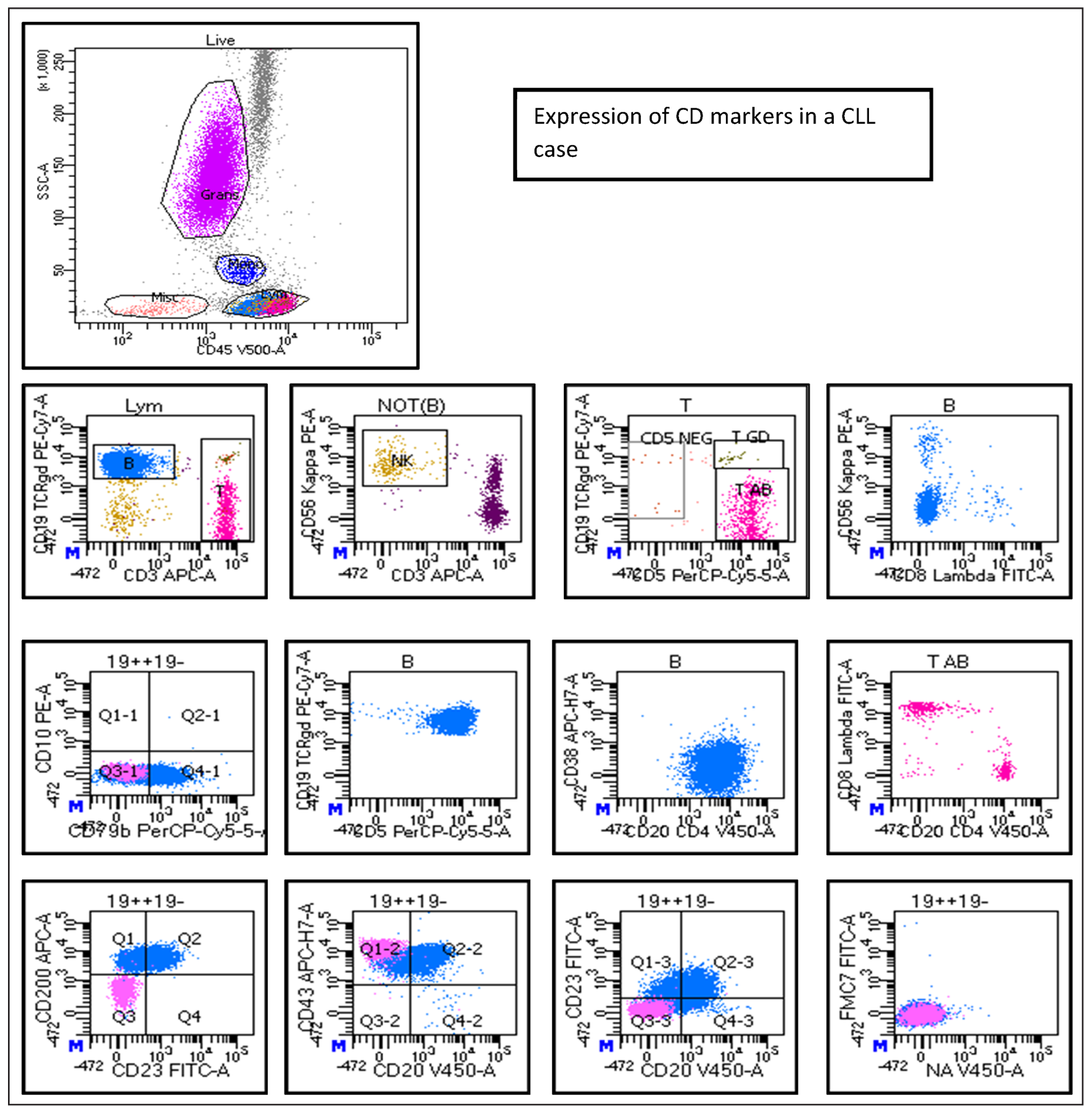 Expression of CD markers in a case of chronic lymphocytic leukaemia. 19++: CD19 positive B cells, 19-: CD19 negative, FITC-A: Fluorescein isothiocyanate.